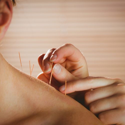 Acupuncture in Solihull Simon Evans Physiotherapy