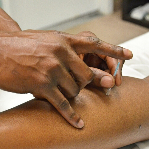 Acupuncture in Solihull Simon Evans Physiotherapy