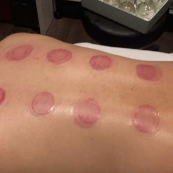 Dry Cupping Therapy Solihull Physiotherapy Simon Evans