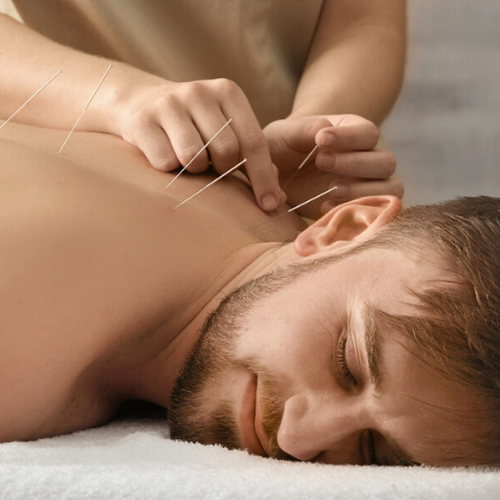 Acupuncture in Solihull Simon Evans Physiotherapy