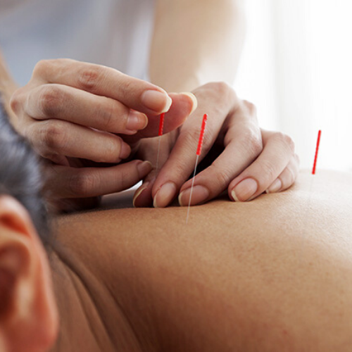 Acupuncture in Solihull Simon Evans Physiotherapy