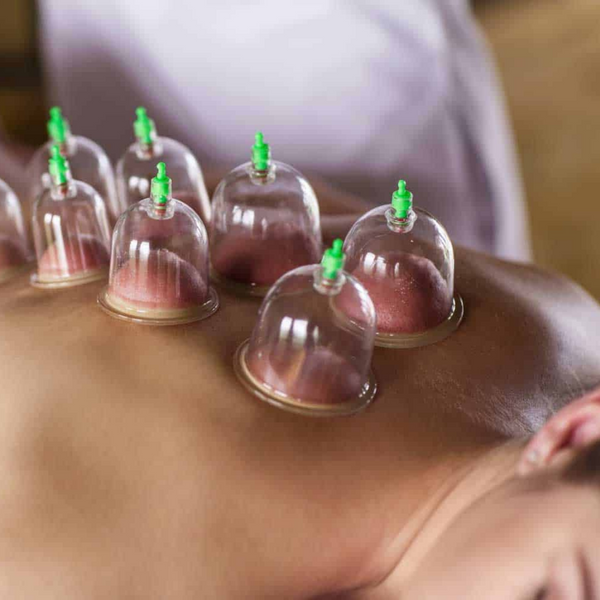 Cupping Therapy Solihull Simon Evans Physiotherapy