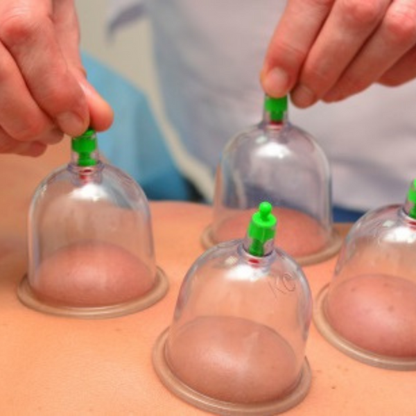 Dry Cupping Therapy Solihull Physiotherapy Simon Evans